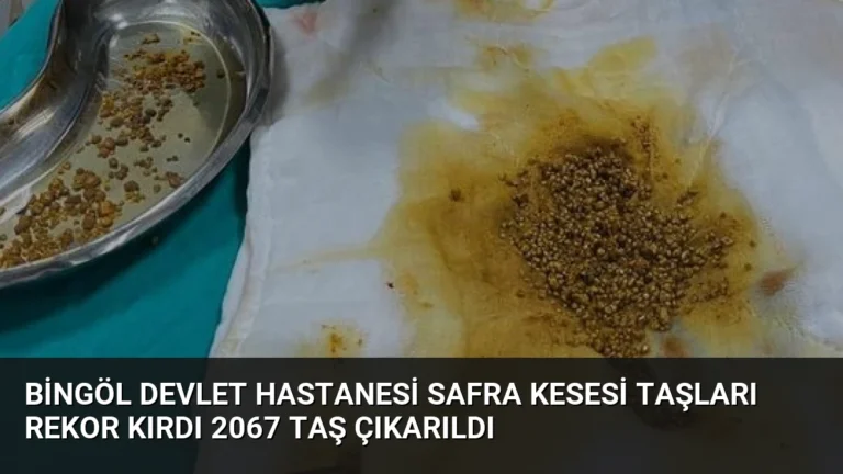 Bingöl Devlet Hastanesi Safra Kesesi Taşları Rekor Kırdı 2067 Taş Çıkarıldı