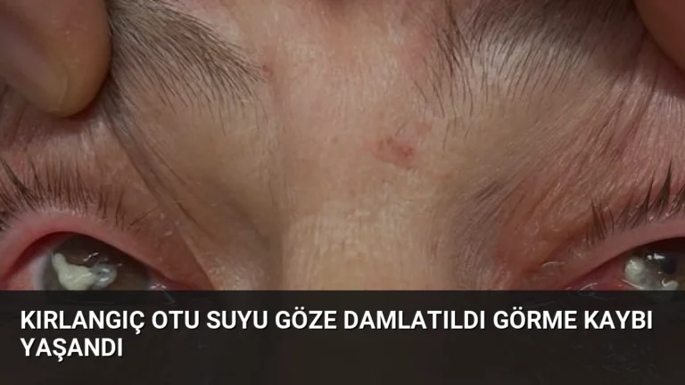 Kırlangıç Otu Suyu Göze Damlatıldı Görme Kaybı Yaşandı