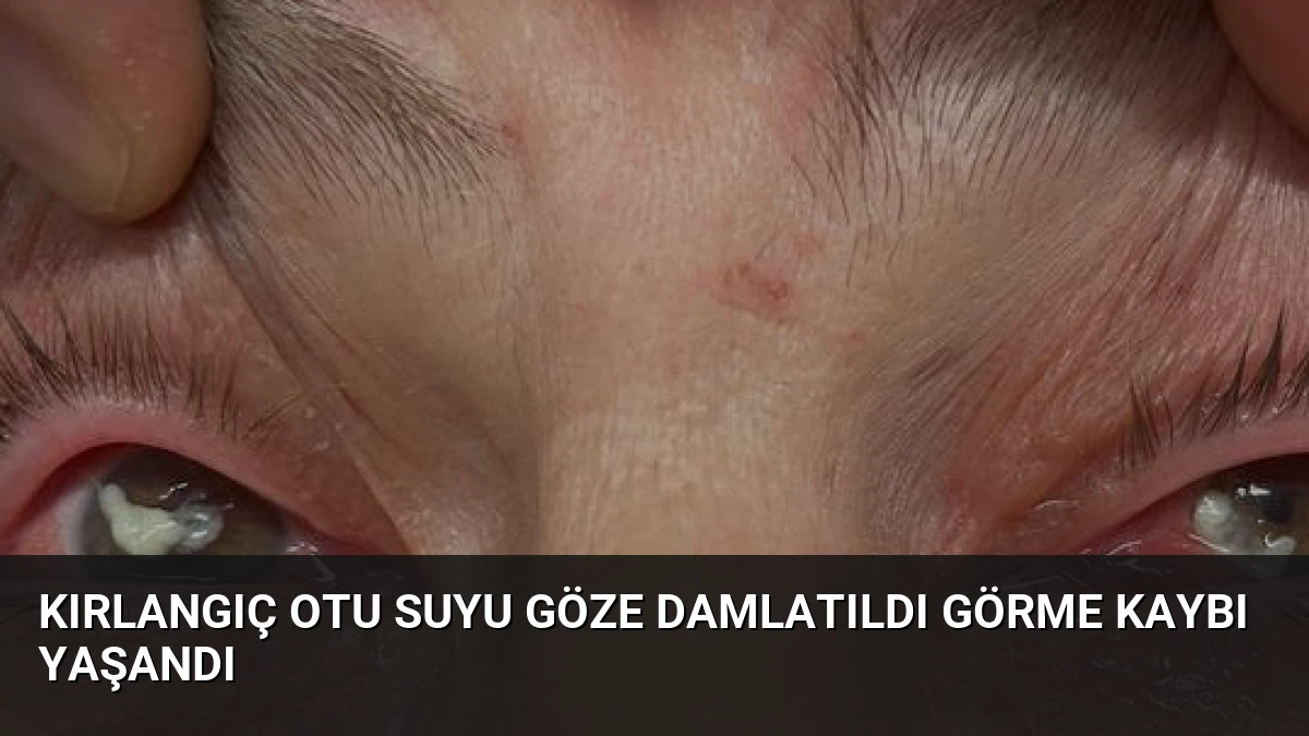 Kırlangıç Otu Suyu Göze Damlatıldı Görme Kaybı Yaşandı